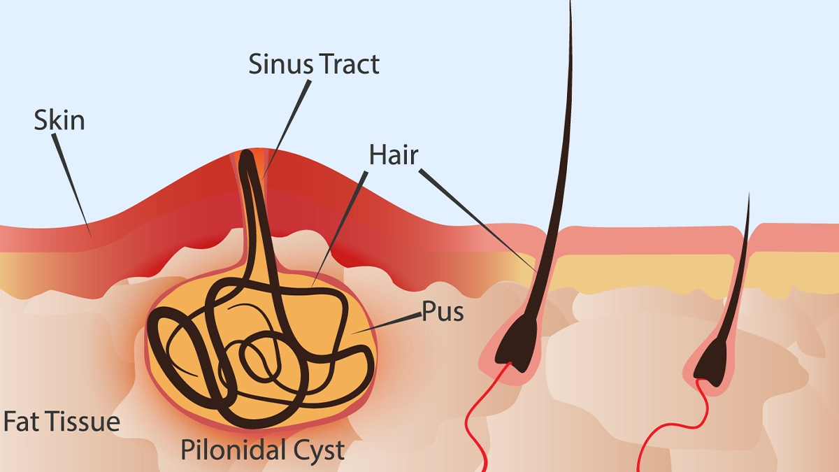 Kıl Dönmesi Plonidal Sinüs